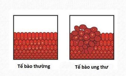 Tế bào ung thư hình thành, phát triển và lan rộng như thế nào?