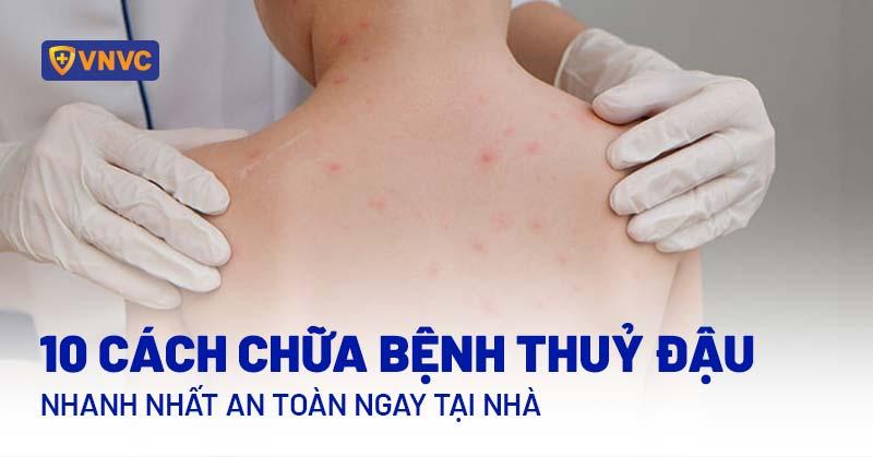 cách chữa bệnh thủy đậu nhanh nhất