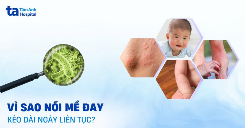 nổi mề đay liên tục