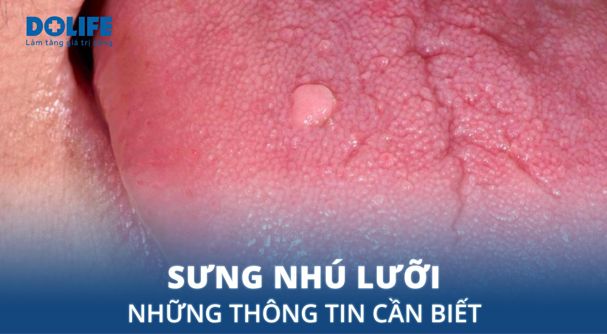 Sưng nhú lưỡi có nguy hiểm không?