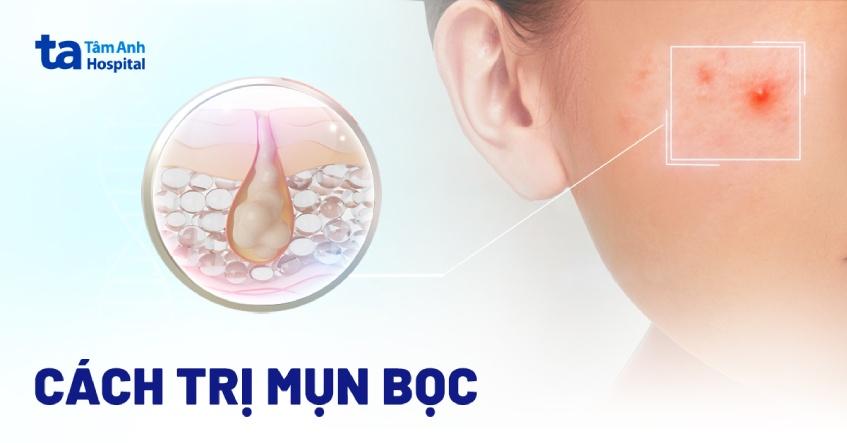 cách trị mụn bọc